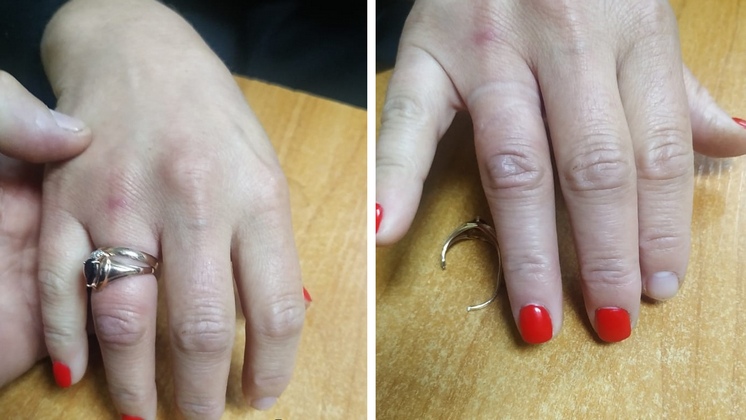 Спасатели сняли кольцо с опухшего пальца 38-летней жительницы Новосибирска
