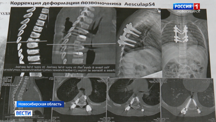 Новосибирские врачи спасли выпавшую из окна трехлетнюю девочку