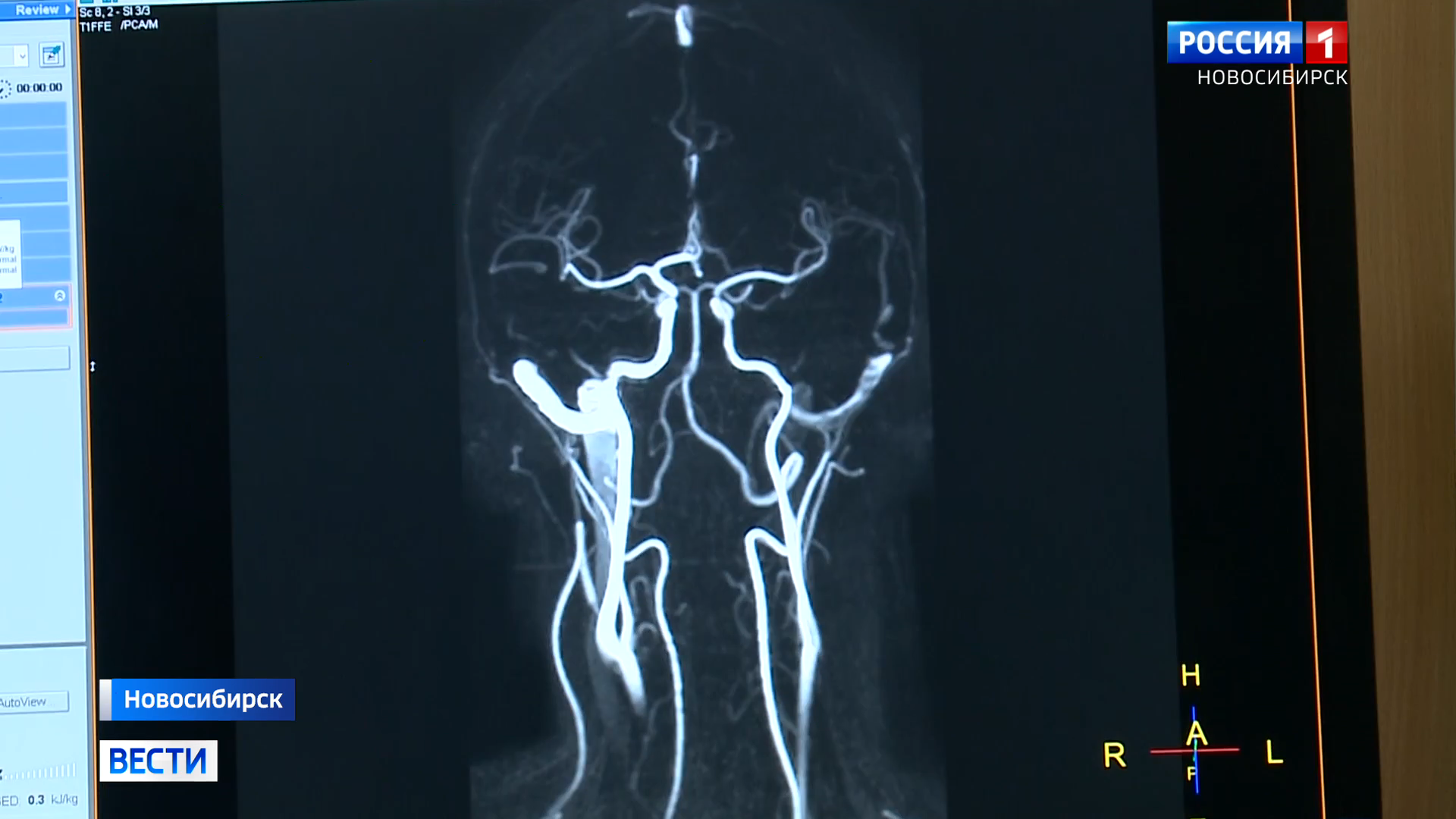 Определить тип и степень тяжести инсульта новосибирским врачам поможет искусственный интеллект