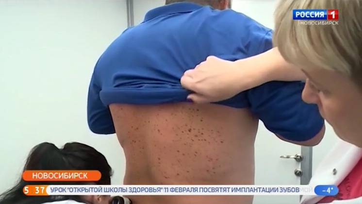 Новосибирские врачи предлагают всем желающим проверить родинки