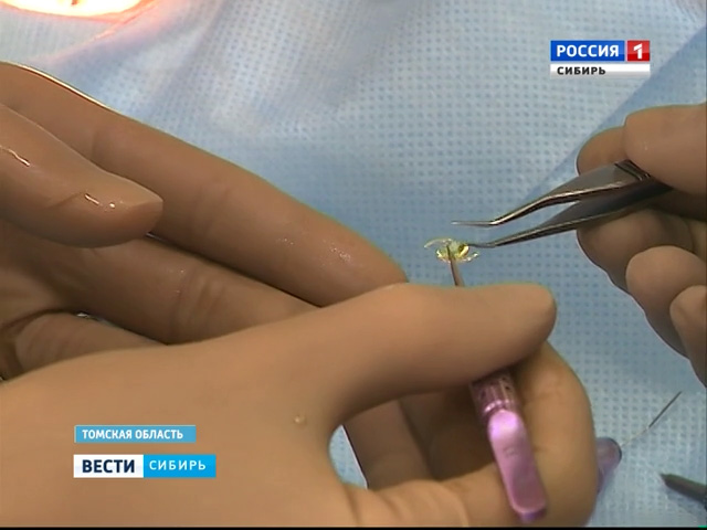 Томские врачи провели операцию по пересадке роговицы глаза