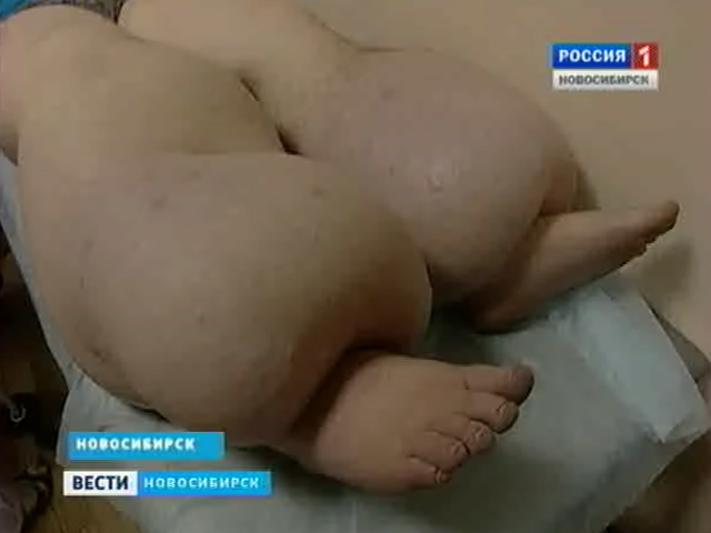 В Новосибирске создают единственный в мире регистр пациентов со &quot;слоновой болезнью&quot;