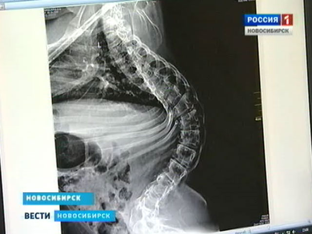 Новосибирские врачи спасли девочку с сильной деформацией позвоночника