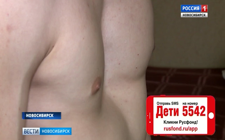 Новосибирскому подростку с деформацией грудной клетки необходима помощь