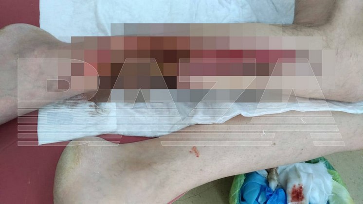 Глава СКР потребовал доклад об ампутации ноги мужчине в Новосибирске