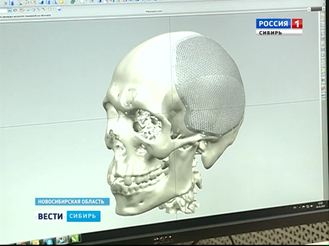 Единственный в Сибири цех 3D-печати изготавливает имплантаты для нейрохирургических операций