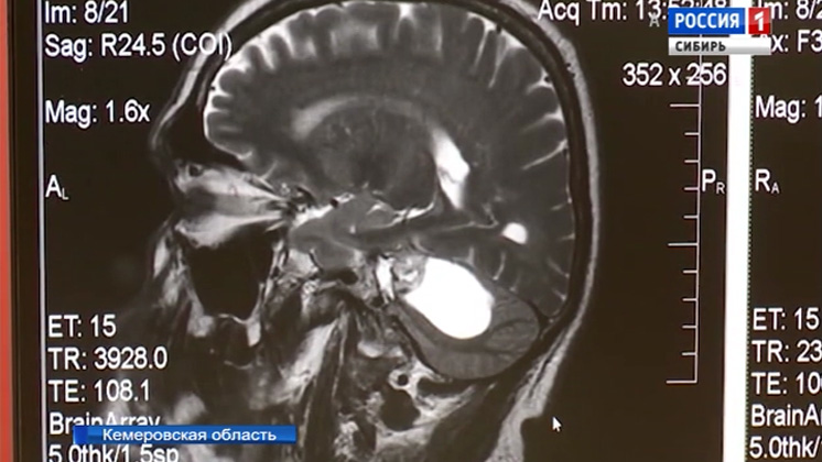 Редчайшую опухоль головного мозга удалили кузбасские врачи