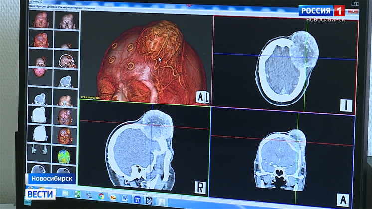 Пациента с огромной опухолью на голове спасли новосибирские нейрохирурги