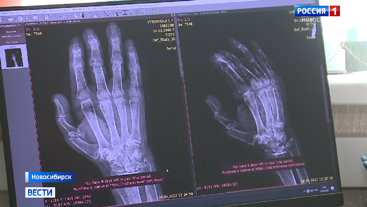 Суставы на пальцах руки заменили пациентке из Южно-Сахалинска новосибирские врачи