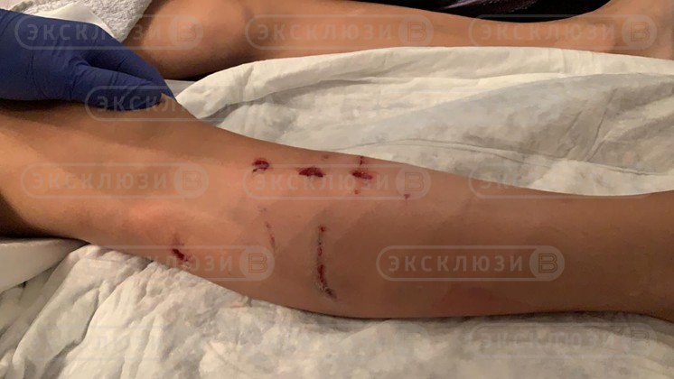 Вцепилась зубами и рвала: в Новосибирске собака напала на 9-летнего мальчика