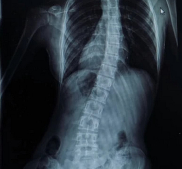 Сколиоз Лилии на рентгене