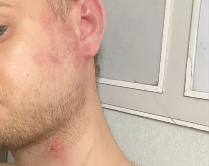 Ушибы на лице и шее потерпевшего.jpg Ушибы на лице и шее потерпевшего.jpg
