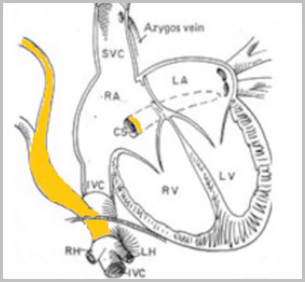 Сердце с «турецкой саблей» 