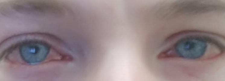 глаза после бассейна