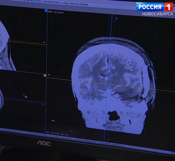 опухоль в головном мозге