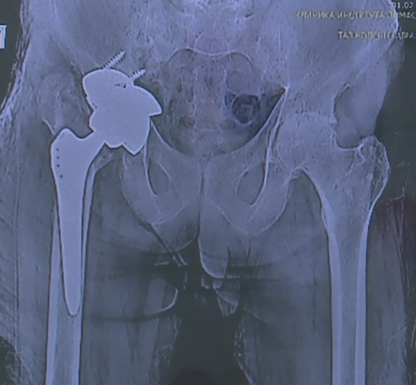 Рентгеновский снимок протеза в человеке