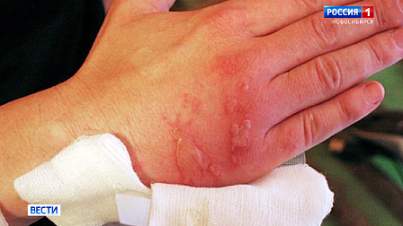 Болезненные волдыри, температура, аллергия: новосибирцы страдают от опасного борщевика