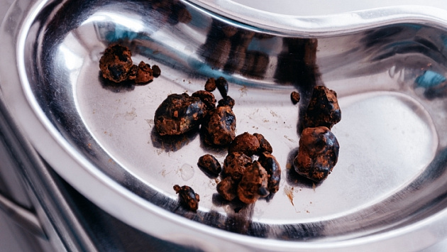 Новосибирские хирурги вытащили из желчного пузыря пациента 15 крупных камней