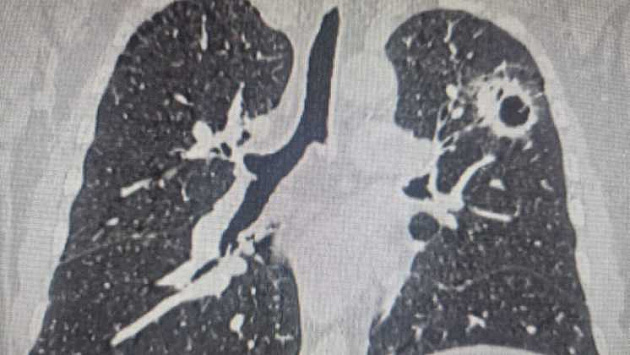 Новосибирские врачи спасли пациента с тремя раковыми опухолями