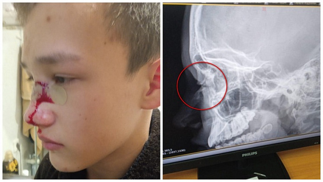 14-летнего мальчика жестоко избили и покалечили во дворе школы на окраине Новосибирска